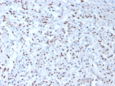 FFPE human mesothelioma sections stained with 100 ul anti-Wilms Tumor 1 (clone WT1/857) at 1:300. HIER epitope retrieval prior to staining was performed in 10mM Citrate, pH 6.0.